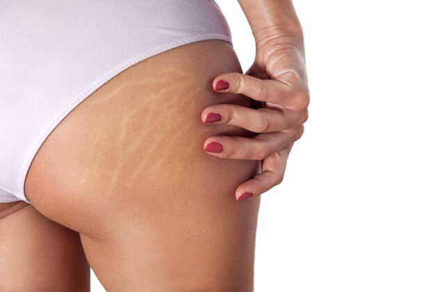 cellulite_vaser shape