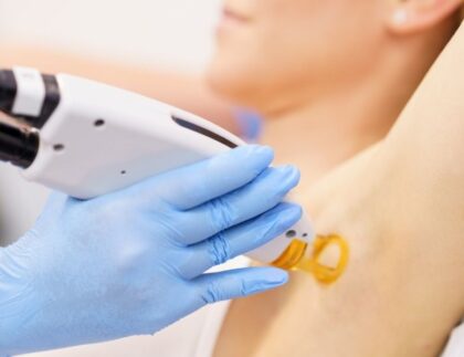 laser hair removal in Annandale, VA